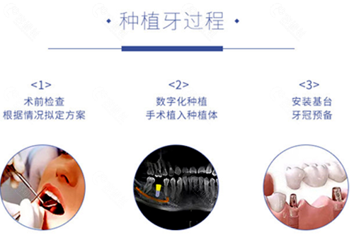 北京佳美口腔种植牙过程图