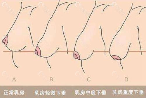胸部下垂分级