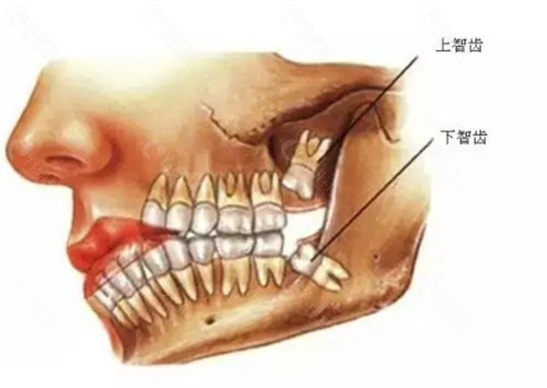 正位智齿拔除