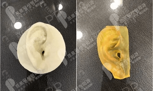 韩国普罗菲耳profile郑在皓院长做耳畸形再造用的人工骨材料