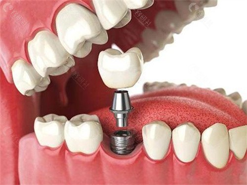 种植牙医生技术对种牙成败影响大吗