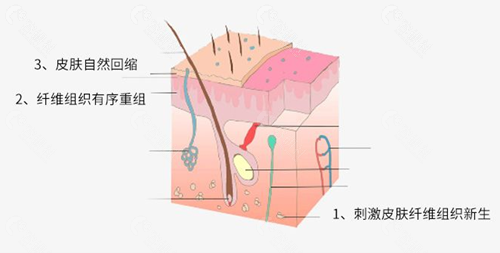 土麦森轻松吸脂3.0优势