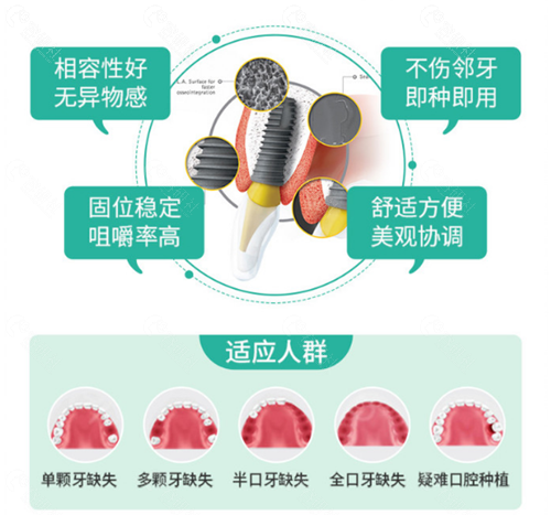 福州贝臣口腔种植牙优势