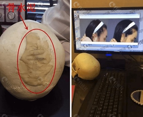 骨水泥填充术后会留疤痕吗？