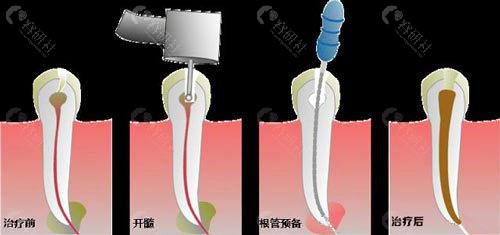 根管治疗过程