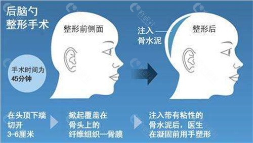 国内骨水泥填充后脑勺好的医院排名