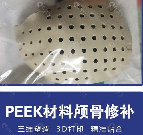 peek材料颅骨修复