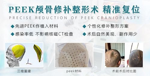 peek颅骨修复整形术