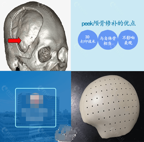 peek颅骨修复优点