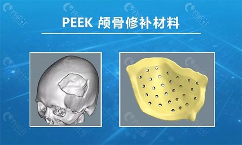 peek颅骨修复材料