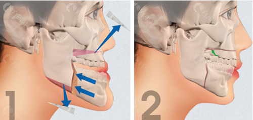 郑广森做正颌手术得多少钱2022凸嘴地包天矫正价目表一览