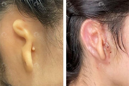 美国耳朵修复健耳移植成功