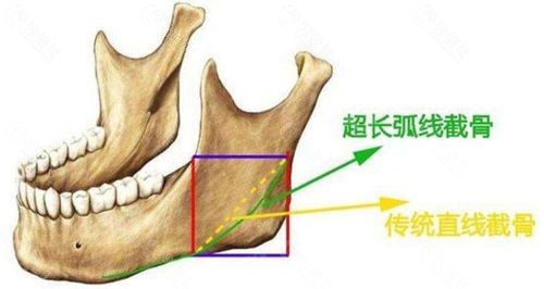 下颌角截骨示意图