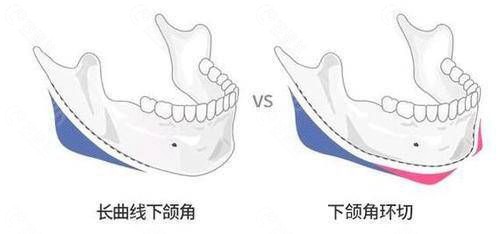 下颌角截骨示意图