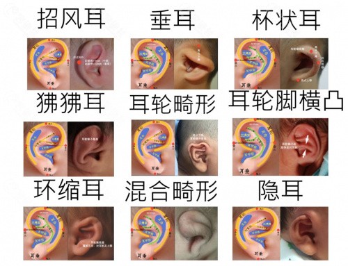 5d仿真义耳有副作用没？