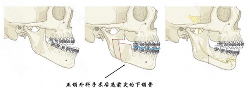 发现地包天后有哪些矫正方法？