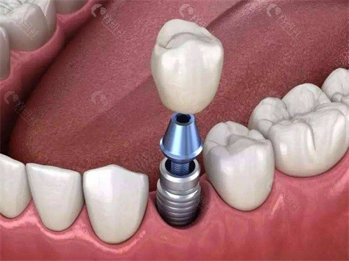 章丘口腔医院种植牙价格表