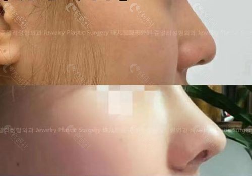 韩国隆鼻失败修复技术好的医生珠儿丽白寅秀隆鼻图片