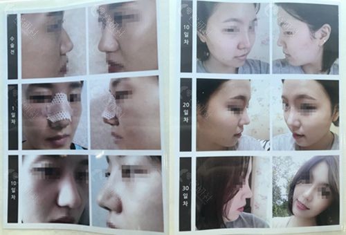 韩国高难度鼻修复名医魏亨坤鼻整形图片分享