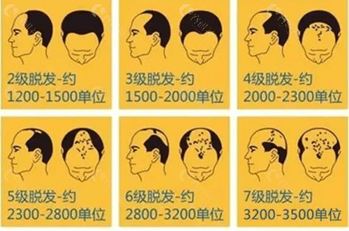 1000单位植发面积 图图片