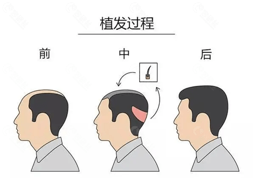 植发1000单位价格