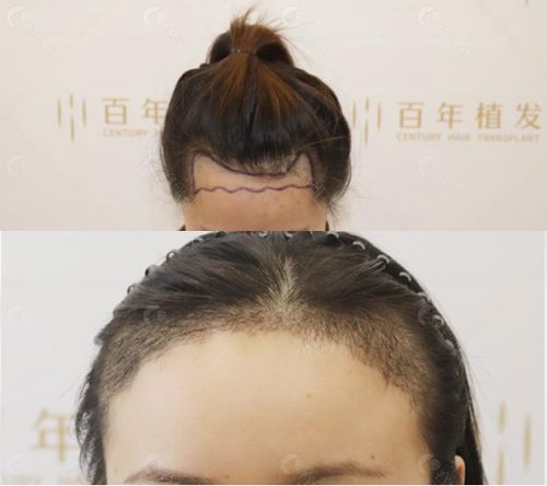 百年植发苏州分院发际线种植收费高吗？