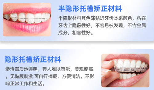 各类牙套的优势