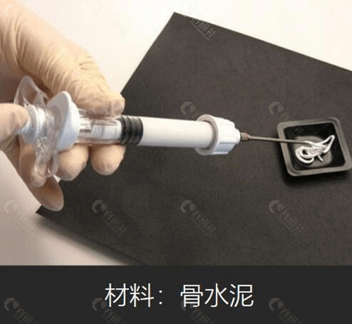 骨水泥填充多少钱
