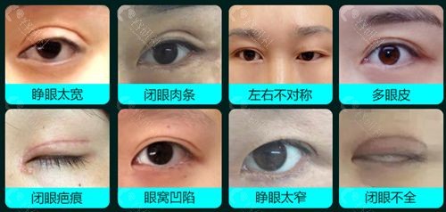 北京擅长高难度双眼皮失败修复医生都有谁？