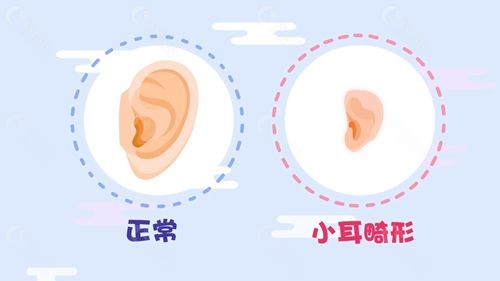 正常耳朵和小耳畸形的区别