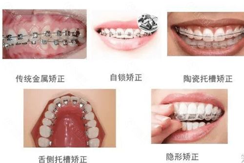 牙齿矫正种类