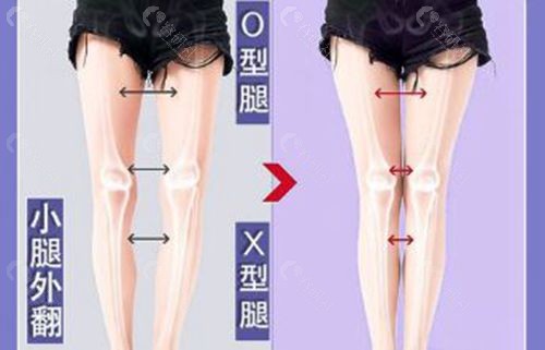 在成都天姿医疗美容做完直腿术后需要多久才能恢复？