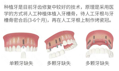 南京江宁江卡瓦口腔单颗、多颗种植牙
