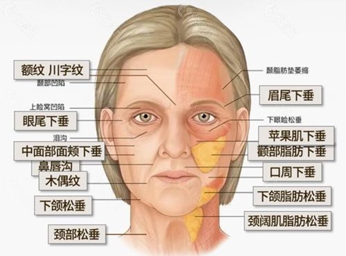 面部提升可以解决脸部哪些问题？北京面部提升哪个医生好？北京做面部拉皮手术需要多少钱？