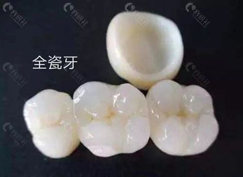 全瓷牙有哪些优缺点？