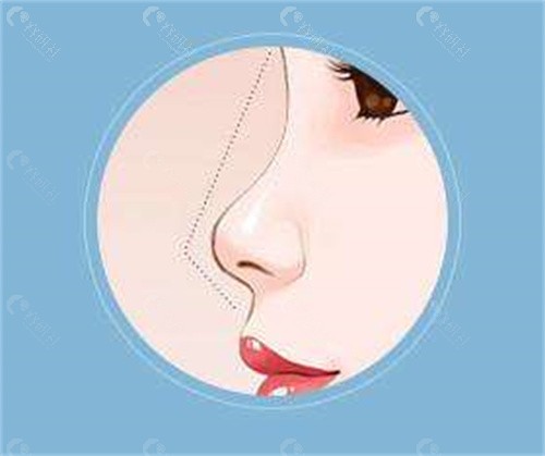 韩国鼻子整形价格表一览
