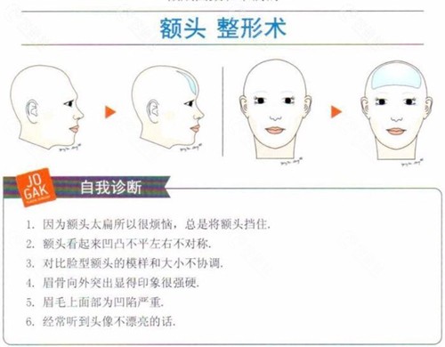 韩国雕刻擅长头部整形手术