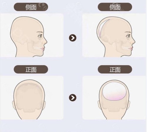 韩国雕刻后脑勺整形前后对比图