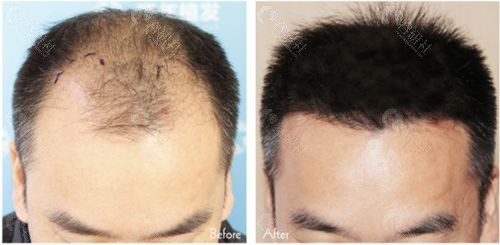 植发后毛发密度是否均匀也是判断植发成功的三个条件之一