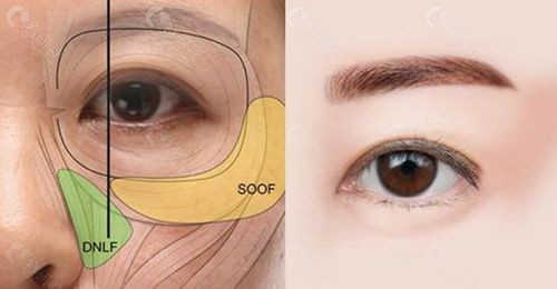韩国大眼睛高汉雄有立体感的眼袋提拉手术核心优势