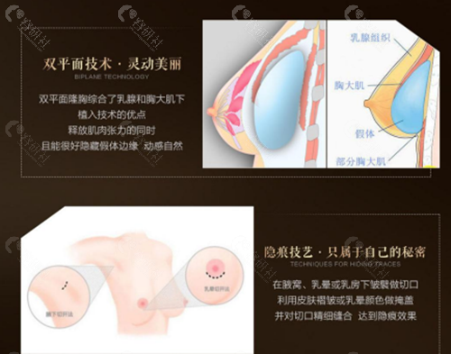 杭州艺星万连壮隆胸优势