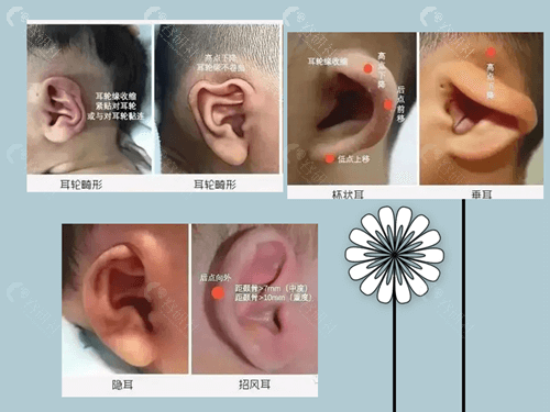 宝宝6种常见畸形耳朵图片