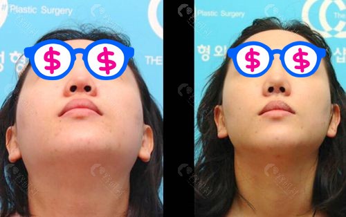 韩国碧夏（Koshop）整形外科李珉仕院长多次隆鼻失败修复图片