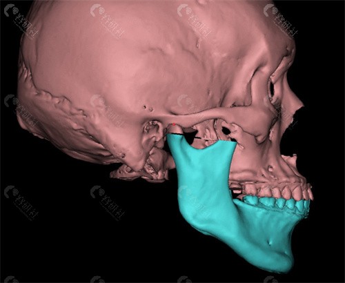 正颌手术模拟图