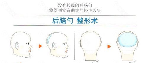 后脑勺整形术