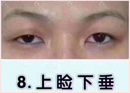 造成上眼睑下垂的原因是什么？