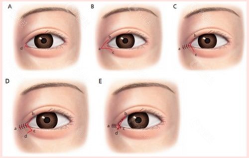 韩国魔法开眼角手术改善了以往开眼角疤痕明显的问题