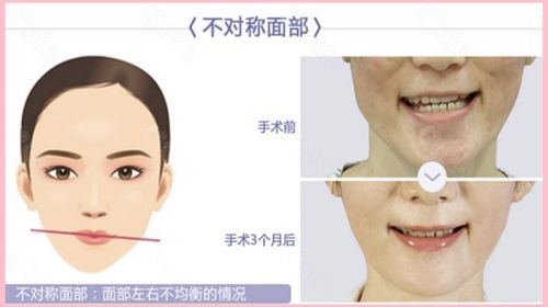 双鄂手术改善面部不对称的问题