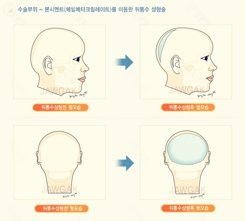 韩国雕刻骨水泥填充前后对比