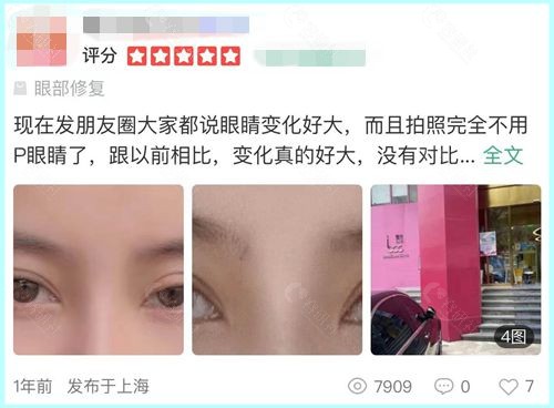 上海双眼皮失败修复厉害的医生杜园园外眼角修复技术口碑评价